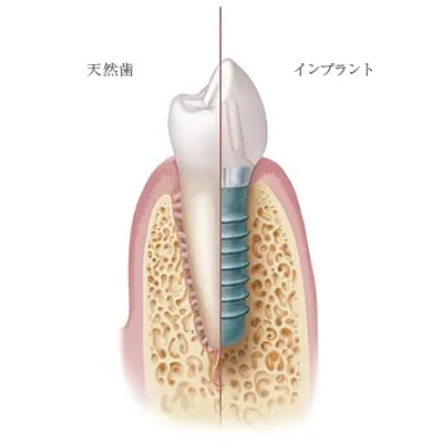 天然歯／インプラントイメージ