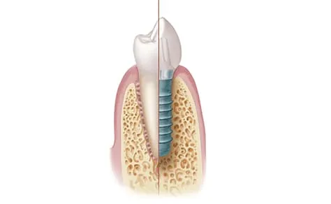 歯科用インプラントイメージ